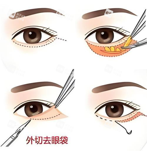 外切去眼袋演示動(dòng)畫圖