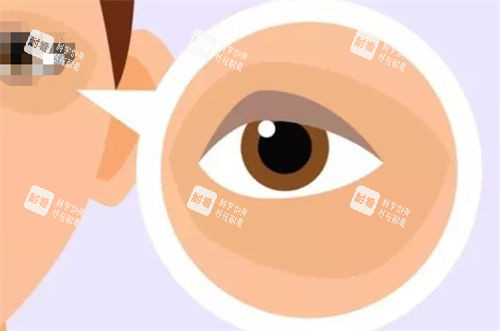 黑眼圈眼袋示意圖