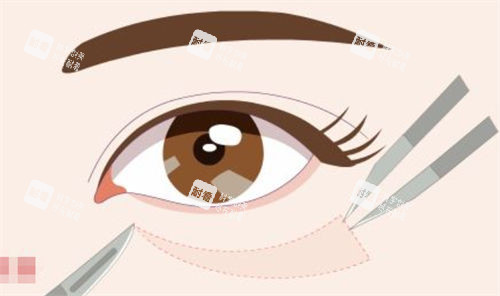去眼袋手術(shù)示意圖
