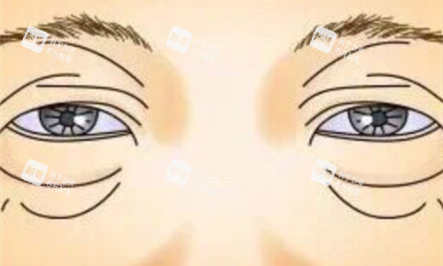 眼袋展示卡通圖