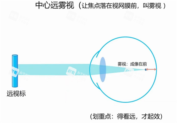 離焦眼鏡治療近視原理圖解