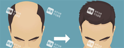 種發(fā)際線前后對比