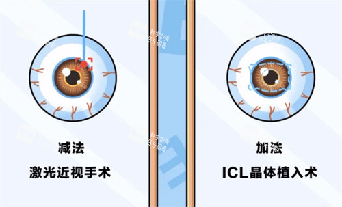 近視手術的分類