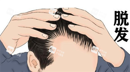 發(fā)際線后移 發(fā)際線后移