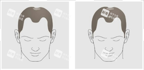 發(fā)際線及頭頂頭發(fā)脫落素材 發(fā)際線及頭頂頭發(fā)脫落素材