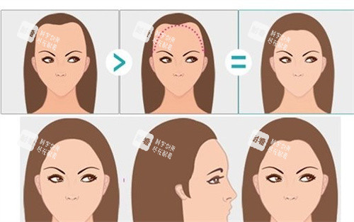 女性m型發(fā)際線卡通圖