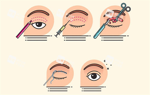 埋線雙眼皮過程卡通圖