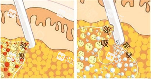 抽脂手術抽脂方式動畫演示圖 抽脂手術抽脂方式動畫演示圖