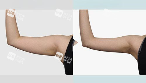 抽脂手術手臂部位前后對比圖 抽脂手術手臂部位前后對比圖