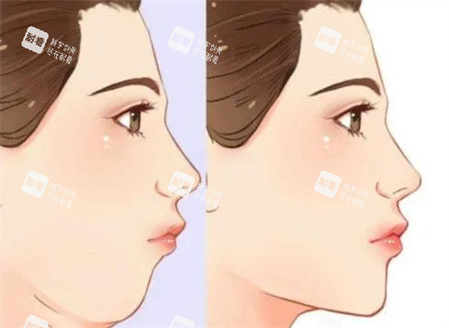 雙下巴抽脂前后對比側(cè)面動畫圖 雙下巴抽脂前后對比側(cè)面動畫圖