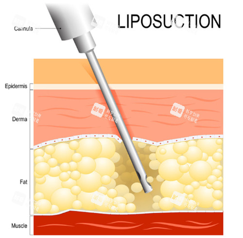 抽脂手術動畫演示 抽脂手術動畫演示