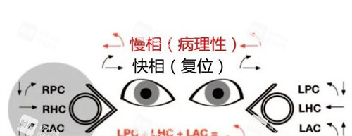 眼球震顫情況分析展示