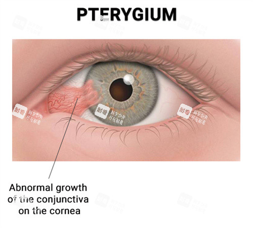 翼狀胬肉對眼睛的影響