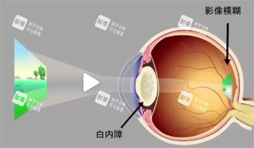 白內(nèi)障成像
