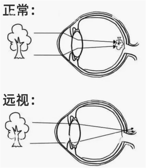 正常眼鏡和遠(yuǎn)視眼睛
