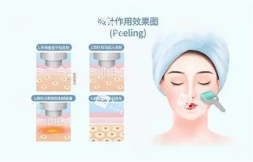 黃金微針作用圖