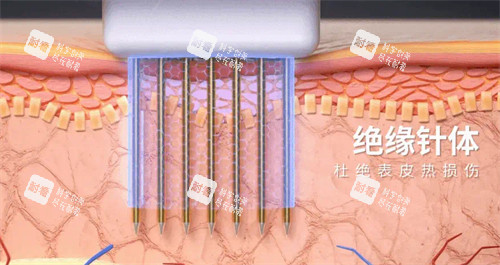 黃金微針針頭圖解