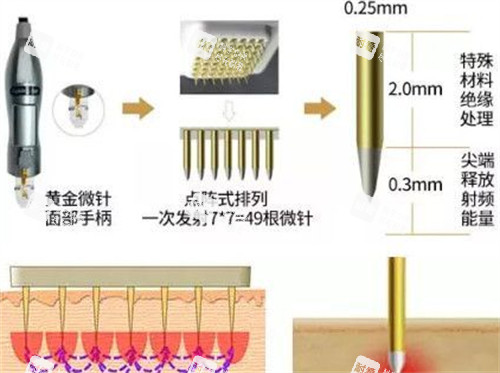 黃金微針手柄介紹