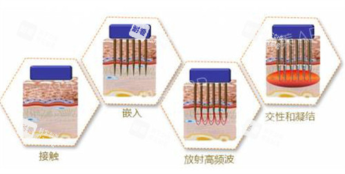 黃金微針原理解析