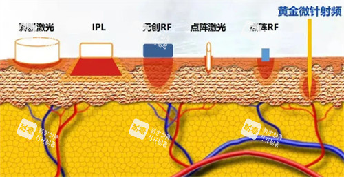 黃金微針射頻層次