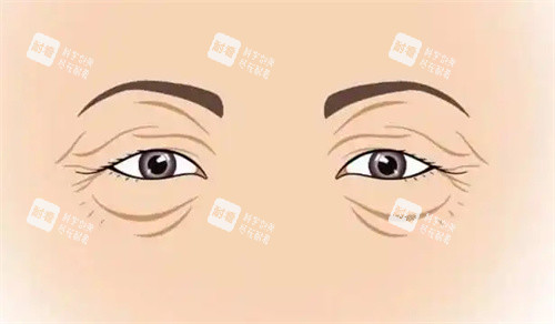 衰老的雙眼皮
