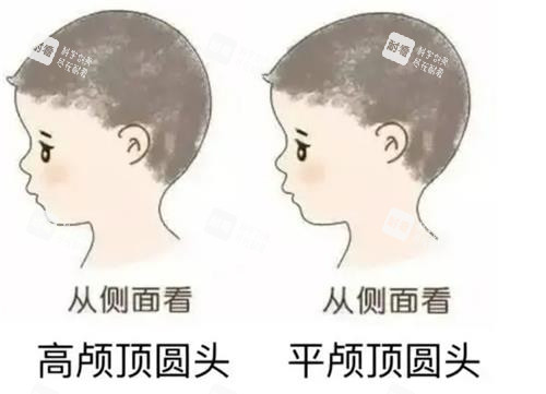 高顱頂和正常頭的對比