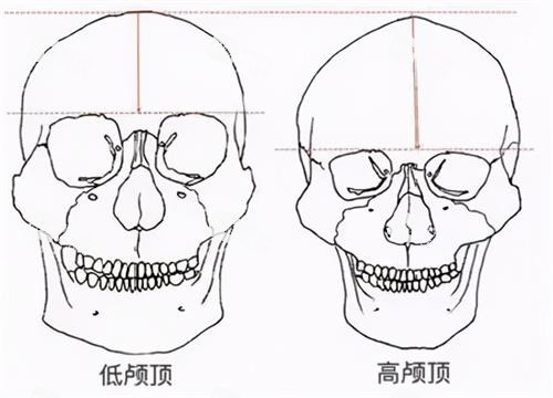 高顱頂和低顱頂?shù)膮^(qū)別