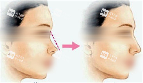 鼻背隆鼻填充前后對比圖