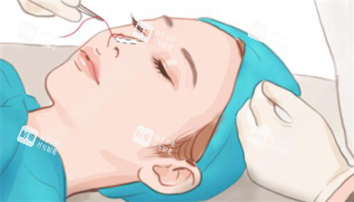 隆鼻手術(shù)示圖