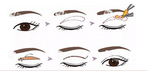 全切雙眼皮過程示意圖 全切雙眼皮過程示意圖