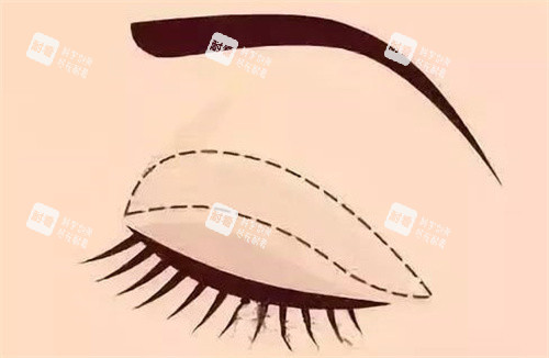 全切雙眼皮 全切雙眼皮