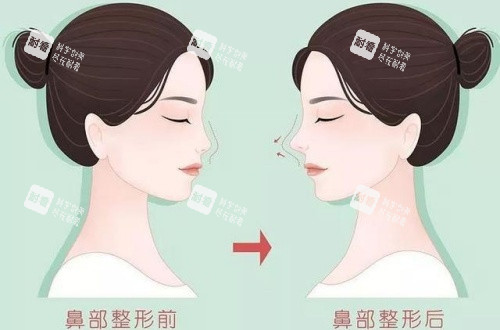 隆鼻術(shù)后漫畫示意圖 隆鼻術(shù)后漫畫示意圖