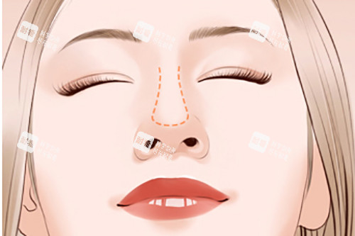 隆鼻鼻梁位置示意圖 隆鼻鼻梁位置示意圖