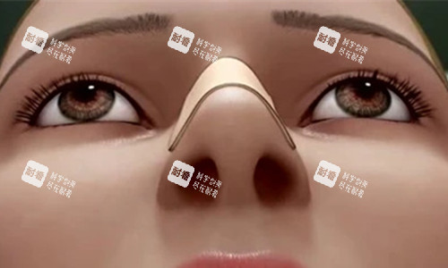 隆鼻卡通圖 隆鼻卡通圖