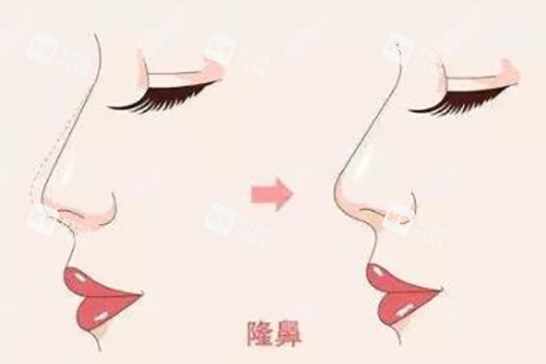 隆鼻對比示意圖 隆鼻對比示意圖