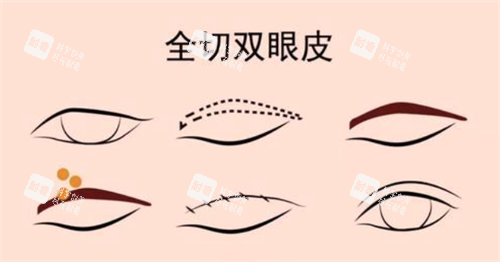 全切雙眼皮經(jīng)過
