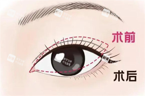 雙眼皮修復(fù)手術(shù)對比
