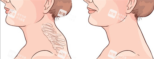 富貴包吸脂前后對(duì)比