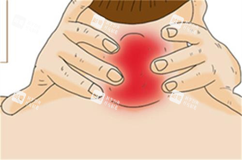 自測(cè)是否有富貴包的方法圖解