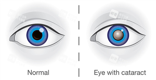 正常眼睛和白內障眼睛不同