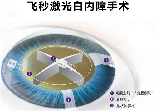 飛秒白內障手術細節(jié)圖