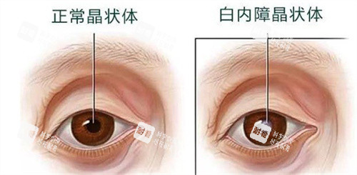 正常晶狀體和白內障晶狀體