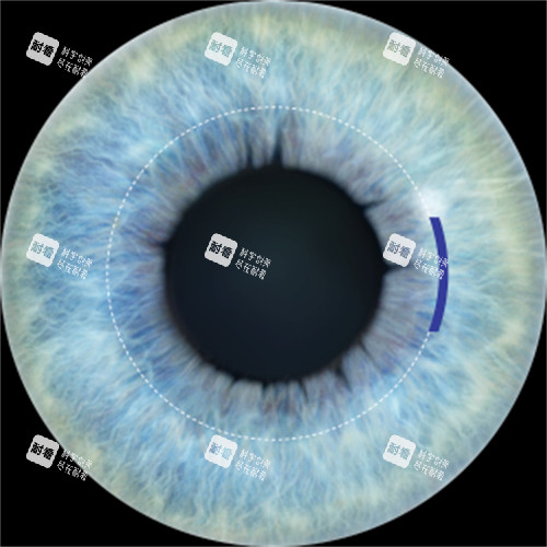 全飛秒手術切口展示 全飛秒手術切口展示