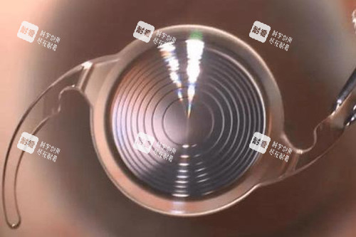 白內(nèi)障晶體圖片 白內(nèi)障晶體圖片