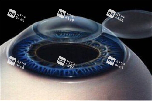 近視眼手術(shù)1 近視眼手術(shù)1