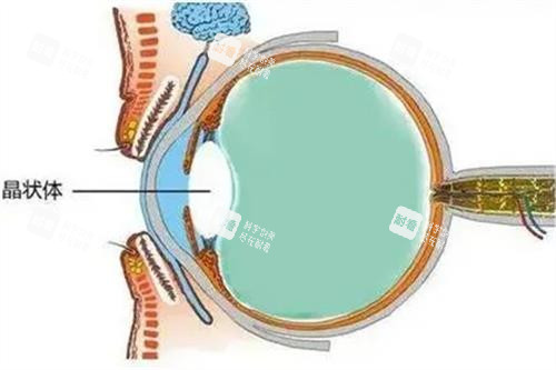 老花眼手術(shù)