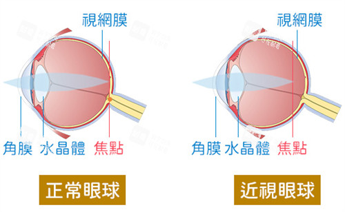 正常眼球和近視眼球的區(qū)別圖解 正常眼球和近視眼球的區(qū)別圖解