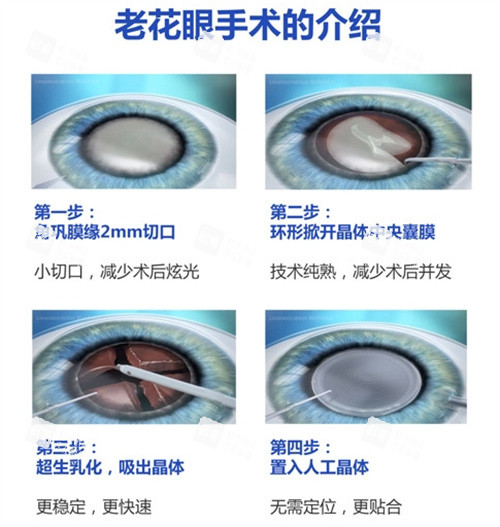 老花眼手術(shù)的介紹