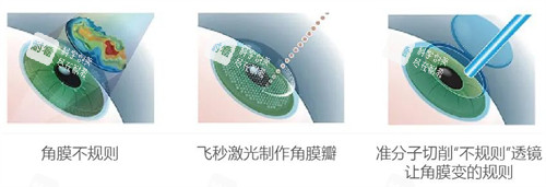 個(gè)性化微飛秒手術(shù)與傳統(tǒng)近視手術(shù)的區(qū)別圖解 個(gè)性化微飛秒手術(shù)與傳統(tǒng)近視手術(shù)的區(qū)別圖解