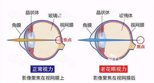 老花眼和正常視力